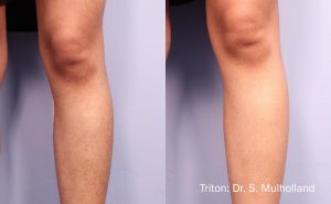 triton-before-after-dr-s-mullholland-preview-1