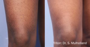 triton-before-after-dr-s-mullholland-preview-3