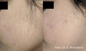 triton-before-after-dr-s-mullholland-preview-5