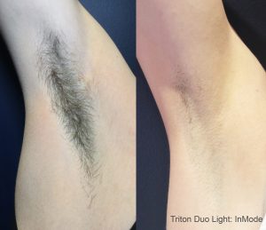 triton-before-after-inmode-preview-1