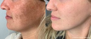 lumecca-before-after-8445-med-spa-preview-1 (2)
