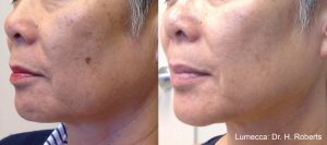 lumecca-before-after-dr-h-roberts-preview-1 (1)