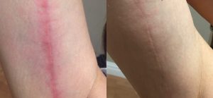 lumecca-before-after-lauren-abramowitz-rpa-c-park-avenue-skin-solutions-preview-1 (2)