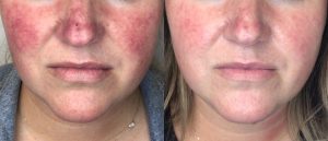 lumecca-before-after-spry-skin-and-wellness-preview-1 (1)
