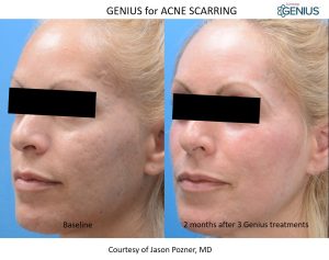 genius rf microneedling before and after