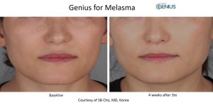 genius rf microneedling before and after