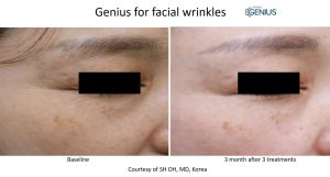genius rf microneedling before and after