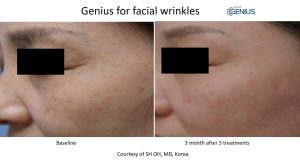 genius rf microneedling before and after