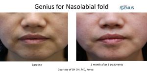 genius rf microneedling before and after
