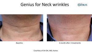 genius rf microneedling before and after