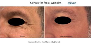 genius rf microneedling before and after