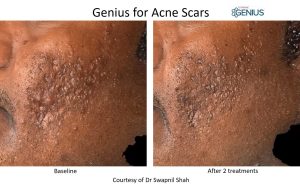 genius rf microneedling before and after